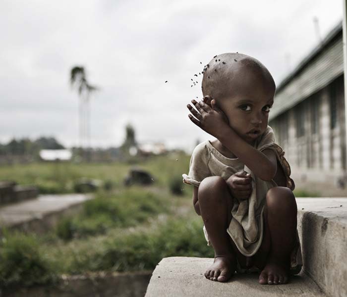 A malnourished boy is portrayed at a feeding center on June 10, 2008 in Damota Pulassa village, southern Ethiopia. Ethiopia said the number of people in need of food aid had risen to 4.5 million from 2.2 million due to failed rains, as it issued a plea for international help. (AFP photo)