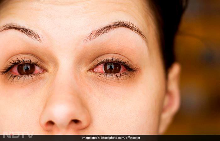 Conjunctivitis: A Look At The Causes, Treatment And Prevention Of The \'Pink Eye