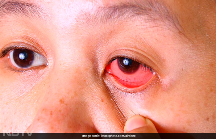 Conjunctivitis: A Look At The Causes, Treatment And Prevention Of The \'Pink Eye