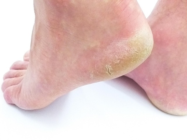 फटी एड़ियों को मुलायम बनाने के लिए करें ये काम