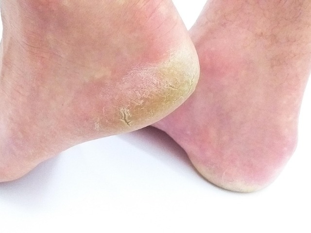 सर्दियों में नहीं फटेंगे हाथ-पैर, रोज़ करें ये 5 काम