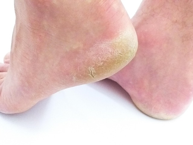 सर्दियों में पैरों के फटने की समस्या से राहत पाने के लिए लगाएं ये चीज़ें