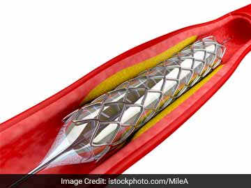  Price Cap On Stents Hailed By All, But Serious Concerns Remain