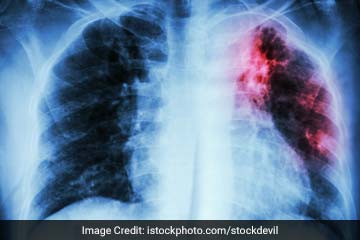 Is Tuberculosis A Dangerous Disease?