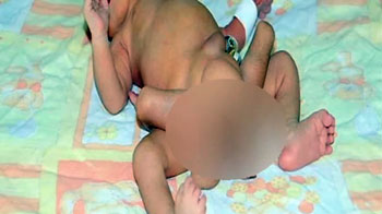 पाक में छह पैर वाले बच्चे का ऑपरेशन पाक में छह पैर वाले बच्चे का ऑपरेशन