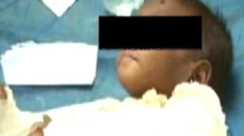 Indore's Baby Falak: Cigarette burns, multiple fractures