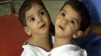 सीने से जुड़ी बच्चियों को मिलेगी जिंदगी