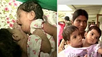 Video : Madhya Pradesh's Siamese twins to be separated tomorrow