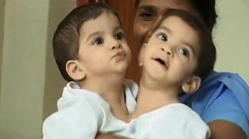 आसान नहीं था जन्म से जुड़ी बच्चियों को अलग करना