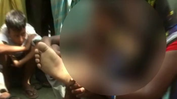 Bihar teen says JD(U) leader tortured him, hammered nails into his foot