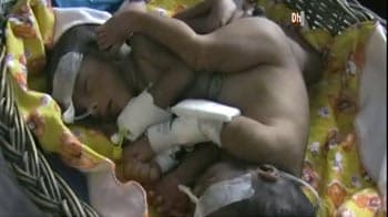 Videos : मध्य प्रदेश : पेट जुड़े दो बच्चे पैदा हुए