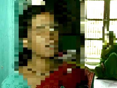 After acid attack, a lonely battle for this 22-year-old woman