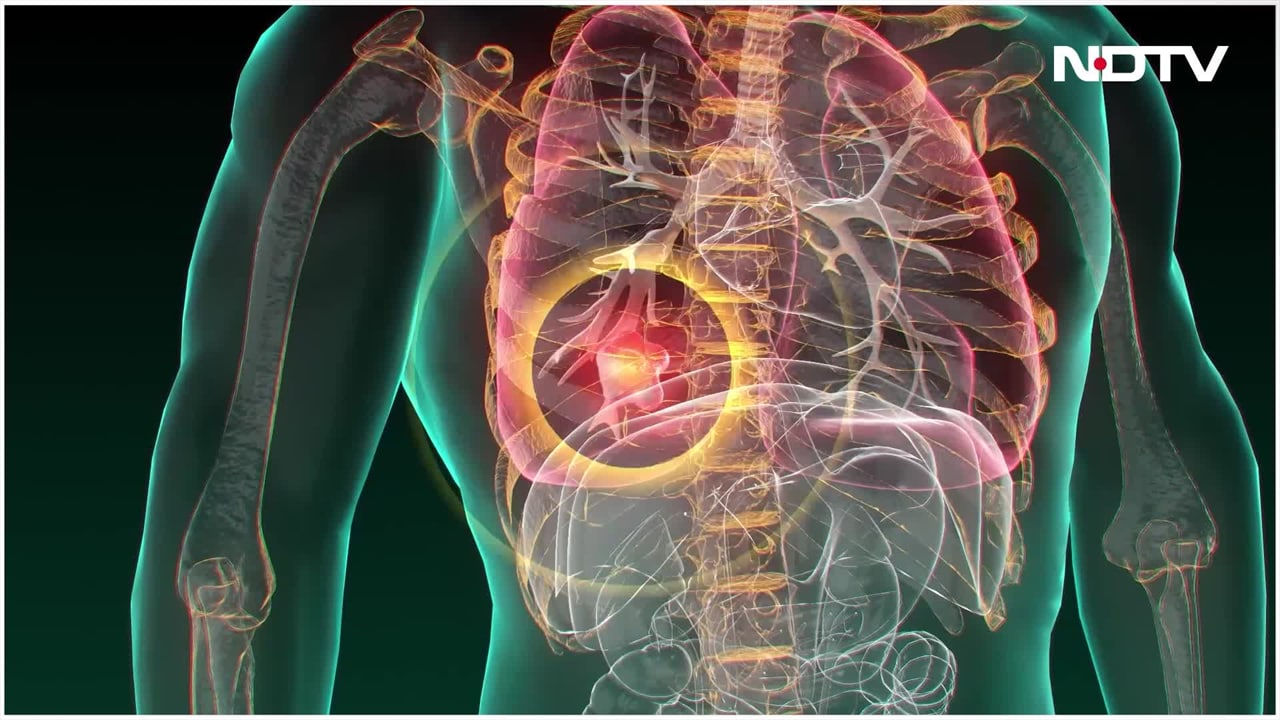 Video : Lungs Infection: इस वजह से होता है चेस्ट या लंग्स में इंफेक्शन, डॉक्टर ने बताया