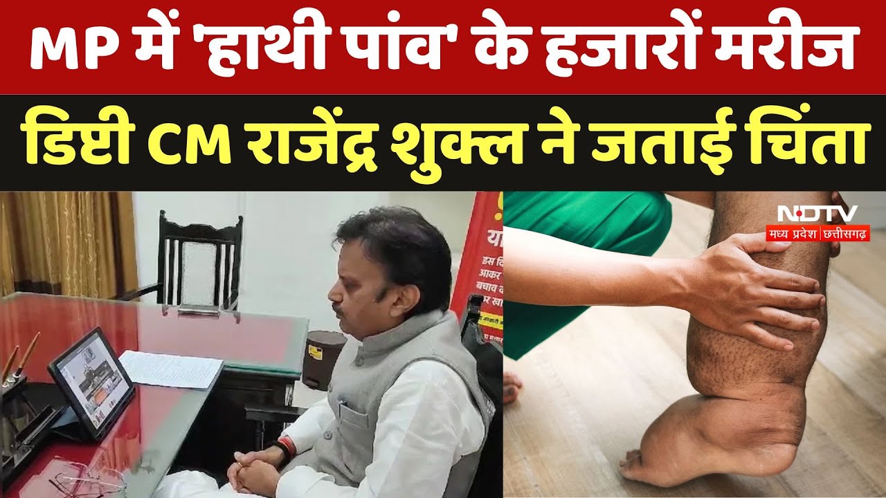 MP में Elephantiasis Disease के 3000 मरीज,  Deputy CM Rajendra Shukla ने JP Nadda से की बात