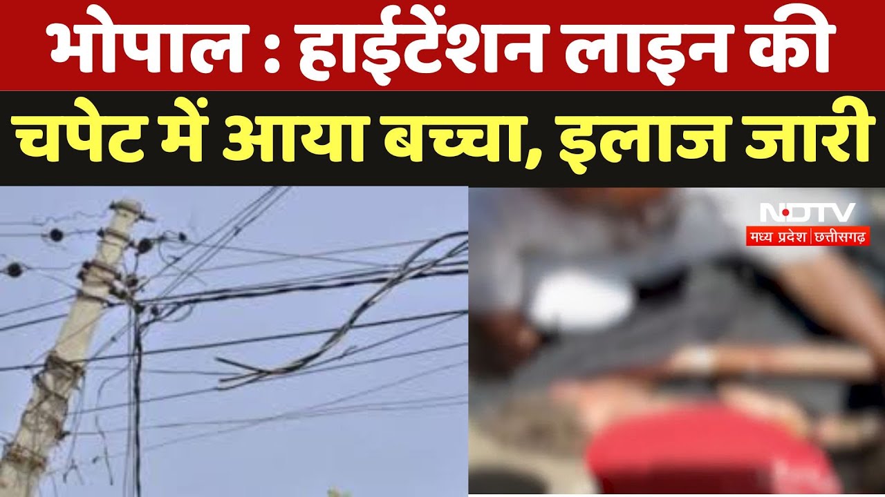 Bhopal News : High Tension Line की चपेट में आया बच्चा, इलाज जारी