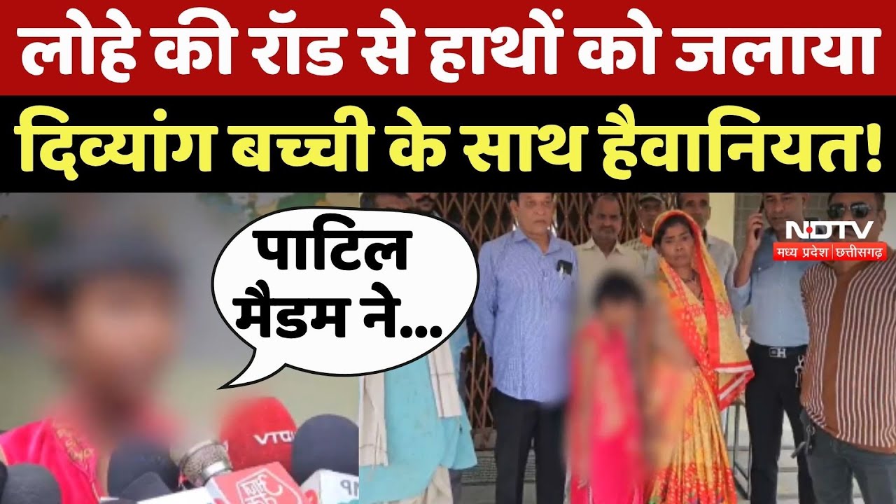 Chhindwara Crime News: लोहे की Rod से हाथों को जलाया, दिव्यांग बच्ची के साथ हैवानियत!