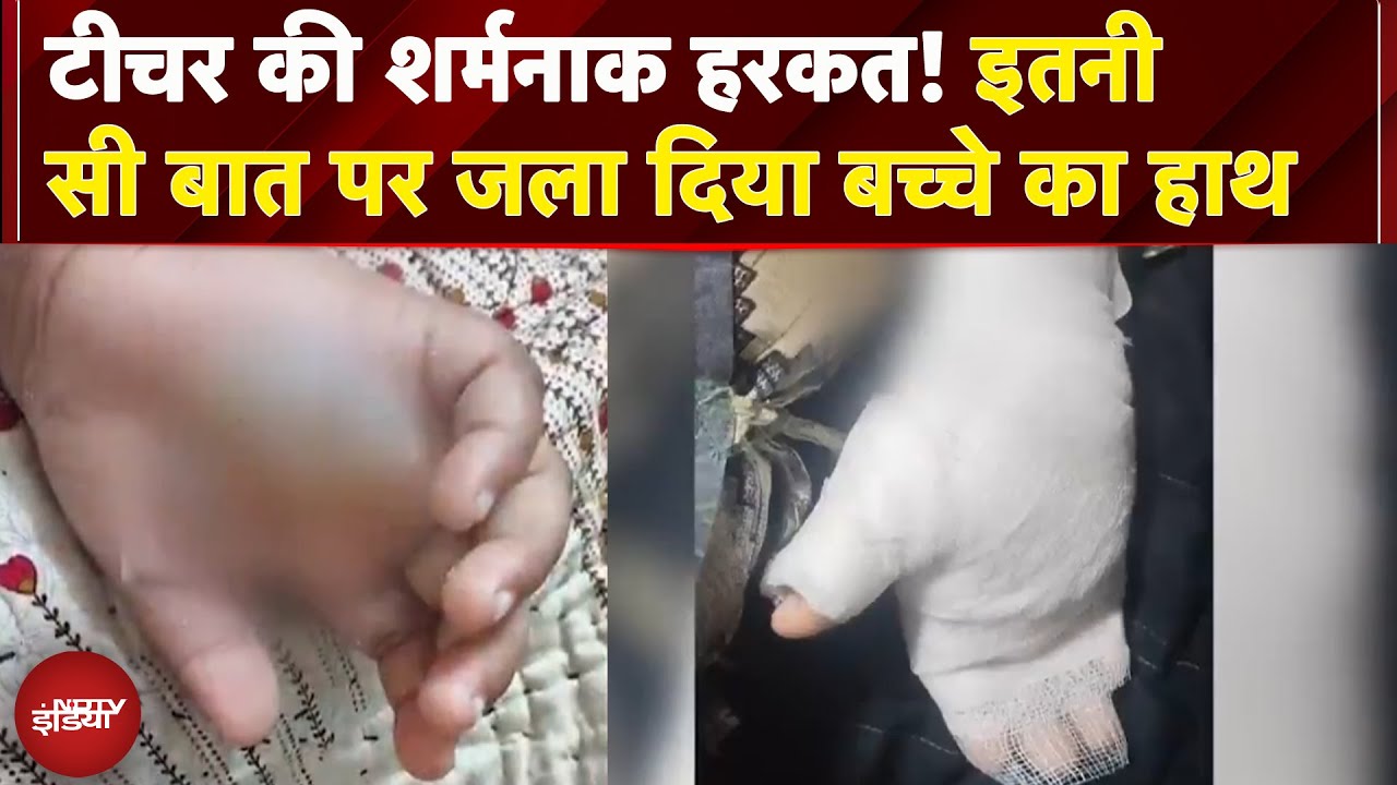 टीचर की शर्मनाक हरकत! इतनी सी बात पर जला दिया 8 साल के मासूम का हाथ | Maharashtra News