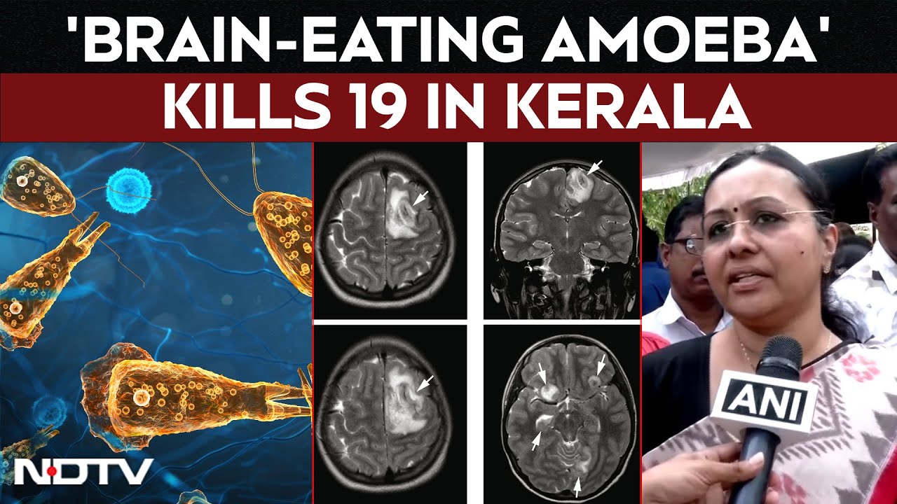 Kerala Amoeba Case | 'Brain-Eating Amoeba' Kills 19 In Kerala. How It Spreads, How To Stay Safe