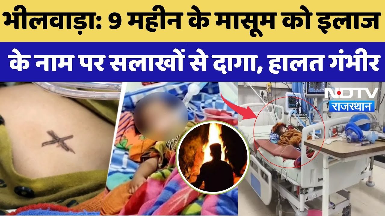 Bhilwara News: 9 महीन के मासूम को इलाज के नाम पर सलाखों से दागा, हालत गंभीर