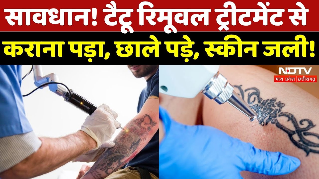 Indore News: Tattoo Removal के गलत Treatment से Infection | Madhya Pradesh | Latest | Top News | MP