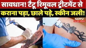 Indore News: Tattoo Removal के गलत Treatment से Infection | Madhya Pradesh | Latest | Top News | MP