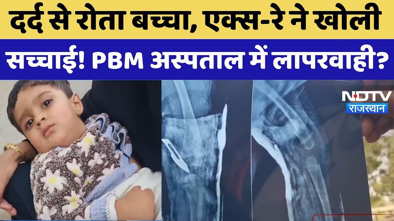Bikaner News : दर्द से रोता बच्चा, एक्स-रे ने खोली सच्चाई! PBM अस्पताल में लापरवाही?। Top News। NDTV