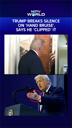 Trump Breaks Silence On 'Hand Bruise', Says It Happened After He 'Clipped' It