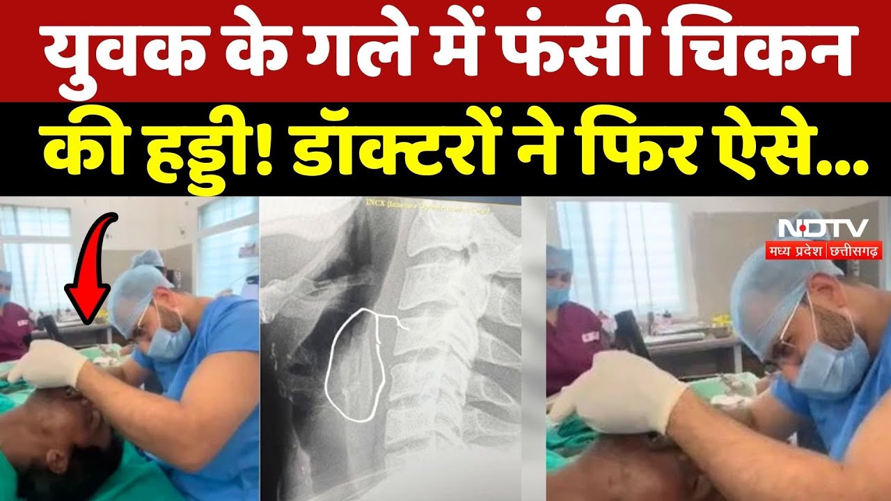 Shajapur Viral News: युवक के गले में फंसी चिकन की हड्डी! Doctors ने फिर ऐसे...
