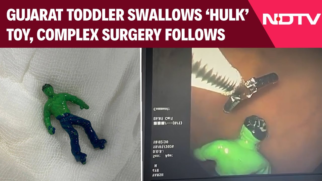 Gujarat News | Gujarat Toddler Swallows 'Hulk', A Complicated Procedure Follows