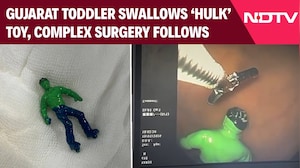 Gujarat News | Gujarat Toddler Swallows 'Hulk', A Complicated Procedure Follows