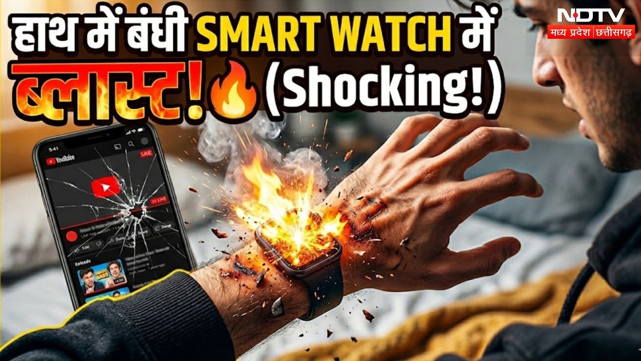 Smartwatch Explosion in Narmadapuram: शादी में अचानक फटी स्मार्ट वॉच, 10 साल के मासूम झुलसा! MP News
