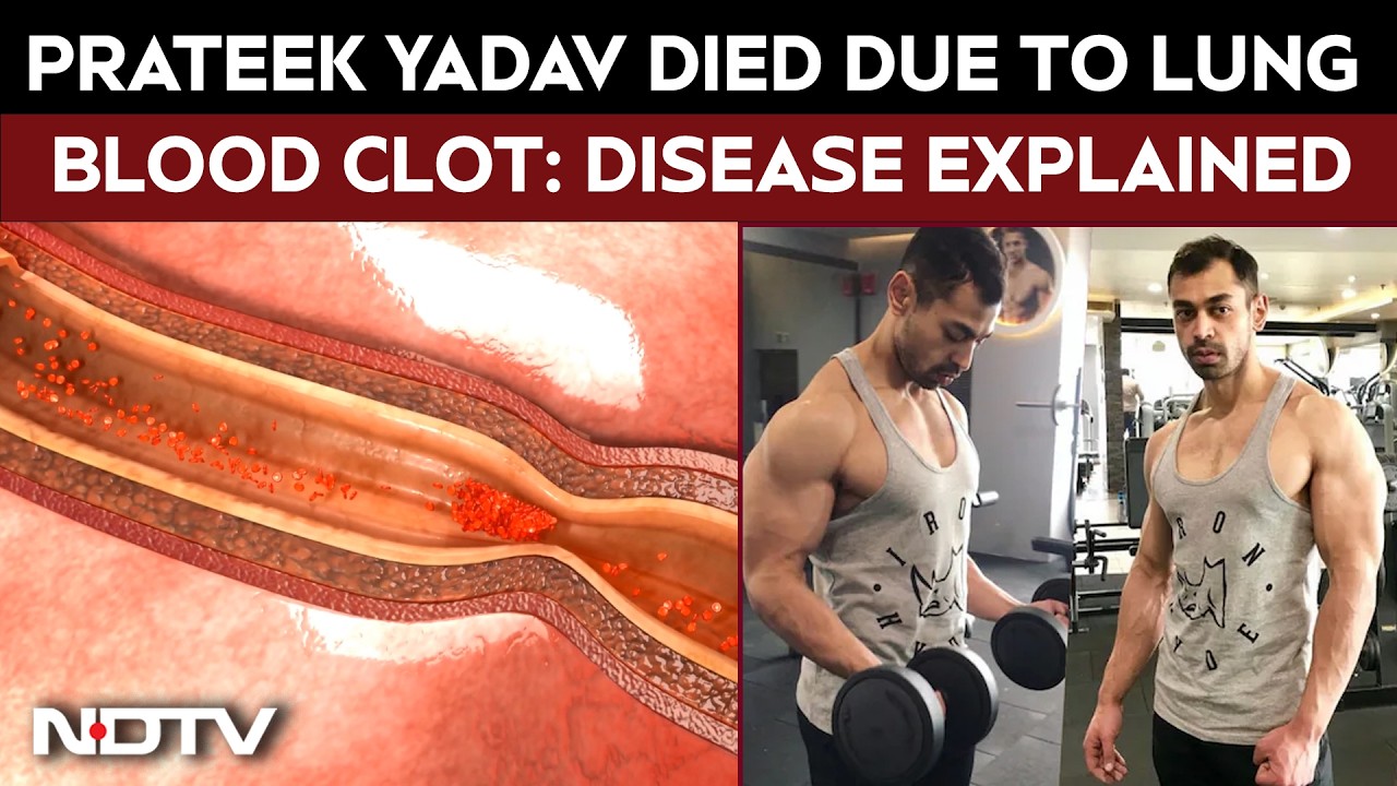 Prateek Yadav Died Of Blood Clot In Lungs: Pulmonary Thromboembolism Symptoms And Causes Explained