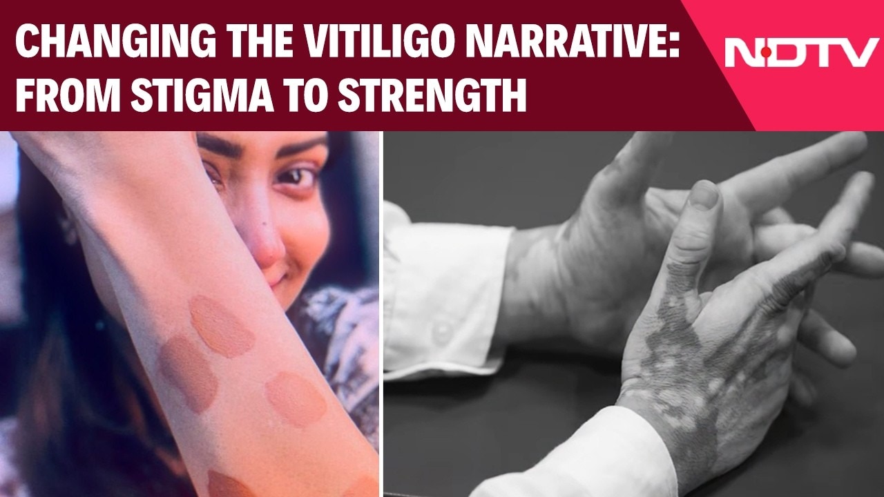 Video: From Stigma to Strength: Kayakalp Global x Indian Vitiligo Association - Beyond Skin