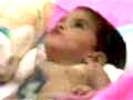 Video : Betul's baby Aradhana passes away, was conjoined twin till recently