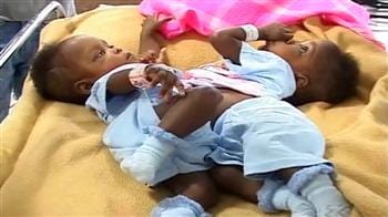 Video : Bangalore: Conjoined twins from Nigeria successfully separated