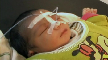 Baby's intestines operated on 'by mistake'