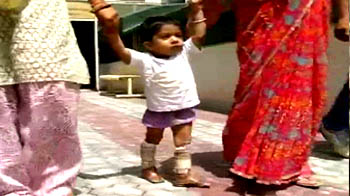 Jaipur Foot gives new lease of life to 2-year-old