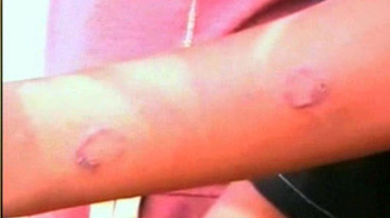 जलती लकड़ी से बच्चों को पीटा