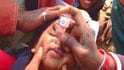Bangalore polio vaccine scare subsidises