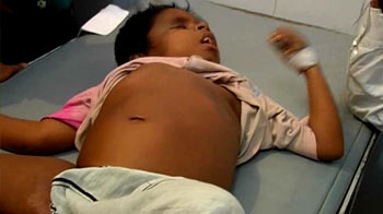 Over 6000 Kala Azar cases reported in Bihar