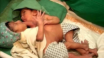 NDTV viewers help conjoined twins