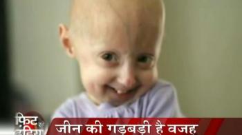 क्या है प्रोजेरिया...?